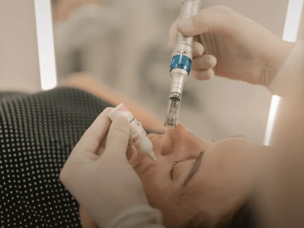 Microagulhamento: como ele acorda o seu próprio colágeno